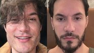 Eliezer mostra antes e depois de reverter harmonização facial - Reprodução/Instagram